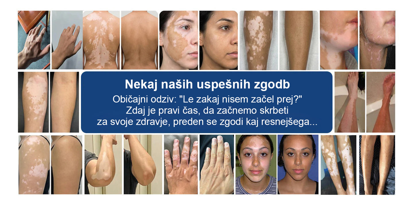 CleraNaure® Piperine Repigment Aktivator Sprej, ki aktivira neaktivne pigmentne celice in povrne naravno barvo kože.