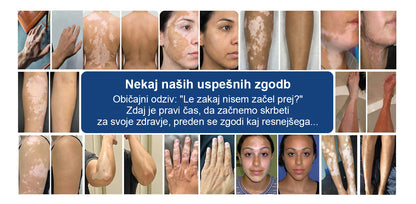 CleraNaure® Piperine Repigment Aktivator Sprej, ki aktivira neaktivne pigmentne celice in povrne naravno barvo kože.