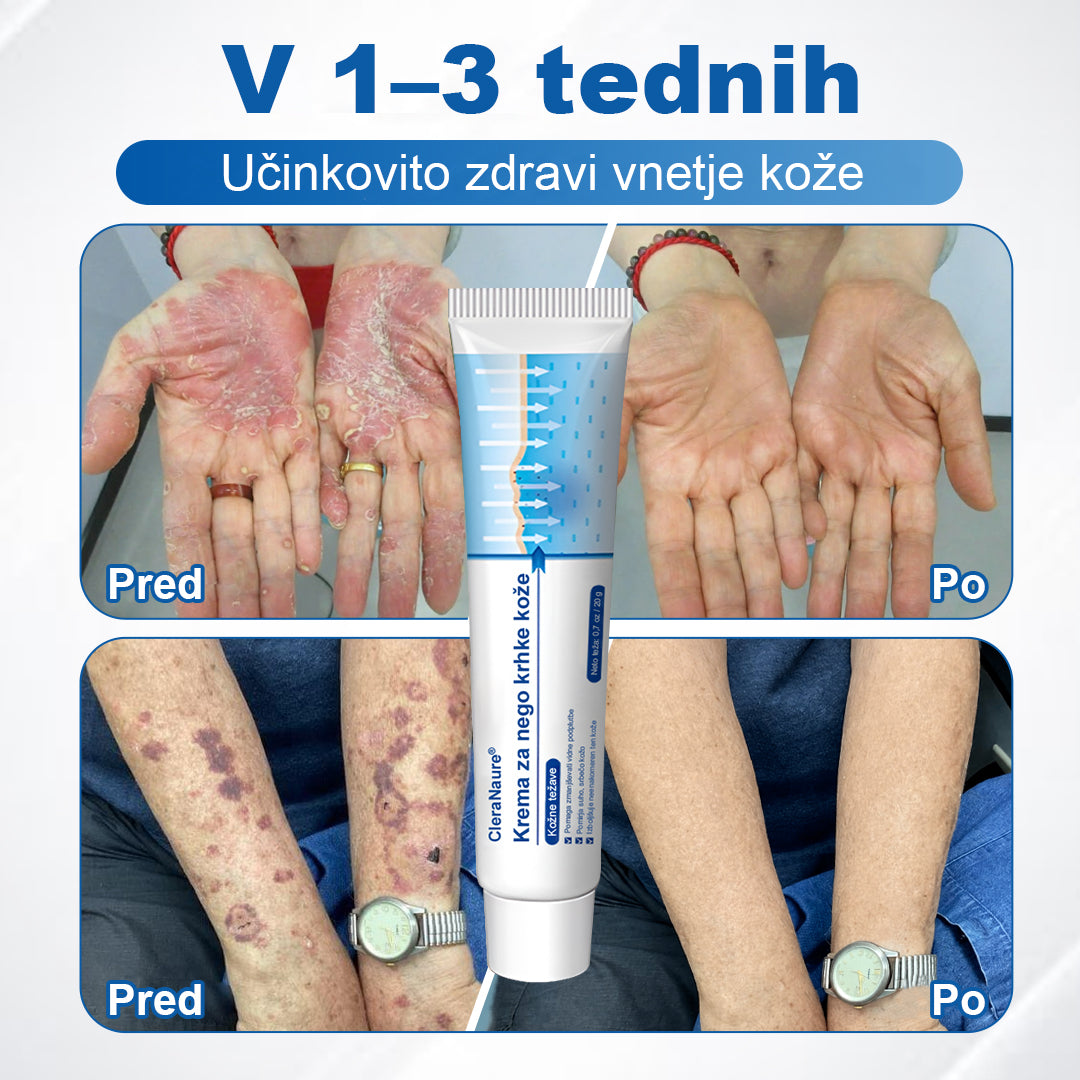 CleraNaure® krema za občutljivo in krhko kožo 🌿 Večnamenska poprava za podplutbe, suhost in madeže