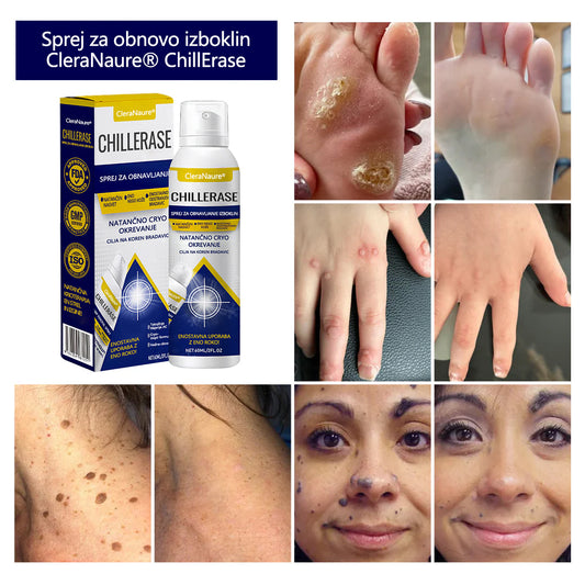 CleraNaure® ChillErase Sprej za pomlajevanje izboklin