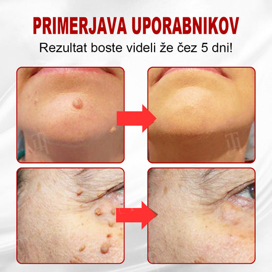 CleraNature® WartAway Pro obliži