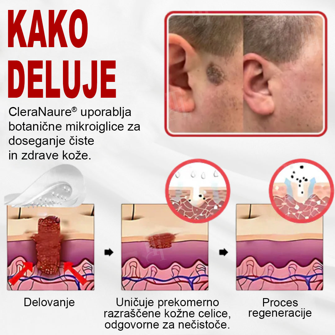 CleraNature® WartAway Pro obliži