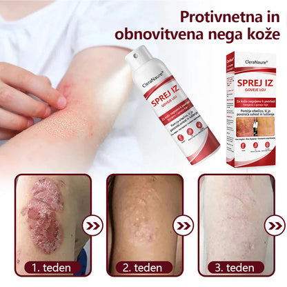 CleraNaure® Beef Tallow Spray za Srbečo in Luščečo Kožo Pri Psoriazi