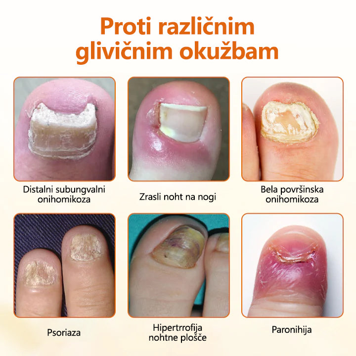 CleraNaure® FungiBee Napreden sprej za obnovo nohtov