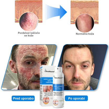 CleraNature® Magnezijev Sprej – Hitro Olajšanje za Srbečo, Rdečo in Občutljivo Kožo (tudi na intimnih predelih)